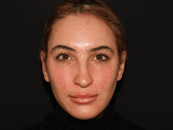 Injectables Gallery - Patient 101410582 - Image 2