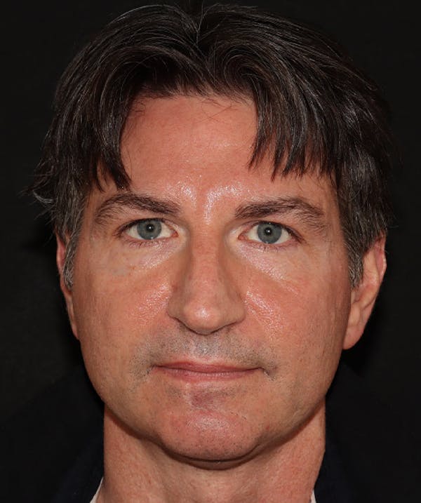 Rhinoplasty Before & After Gallery - Patient 101411692 - Image 1