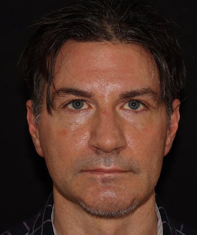 Rhinoplasty Before & After Gallery - Patient 101411692 - Image 2