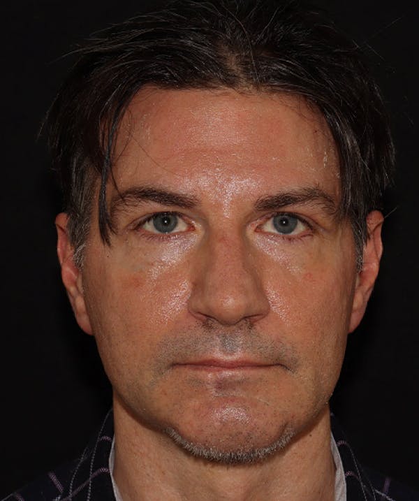 Rhinoplasty Before & After Gallery - Patient 101411692 - Image 2