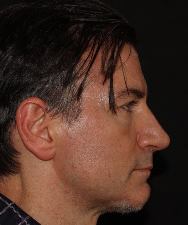 Rhinoplasty Before & After Gallery - Patient 101411692 - Image 4