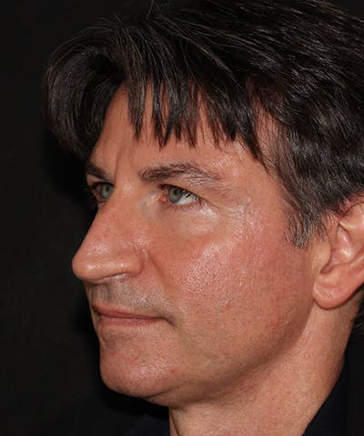 Rhinoplasty Before & After Gallery - Patient 101411692 - Image 5