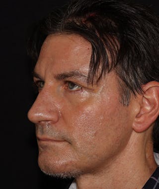 Rhinoplasty Before & After Gallery - Patient 101411692 - Image 8