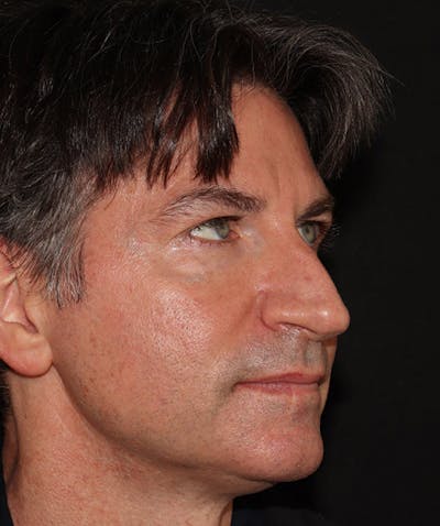 Rhinoplasty Before & After Gallery - Patient 101411692 - Image 7