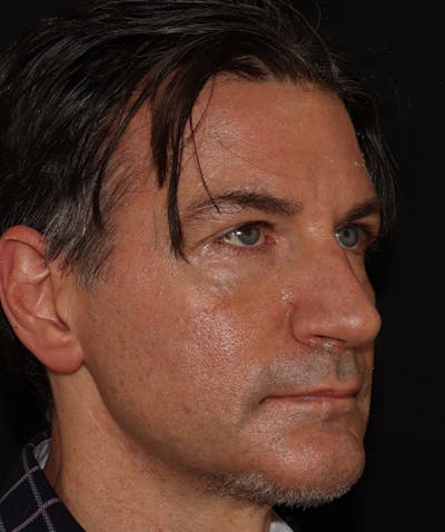 Rhinoplasty Before & After Gallery - Patient 101411692 - Image 8