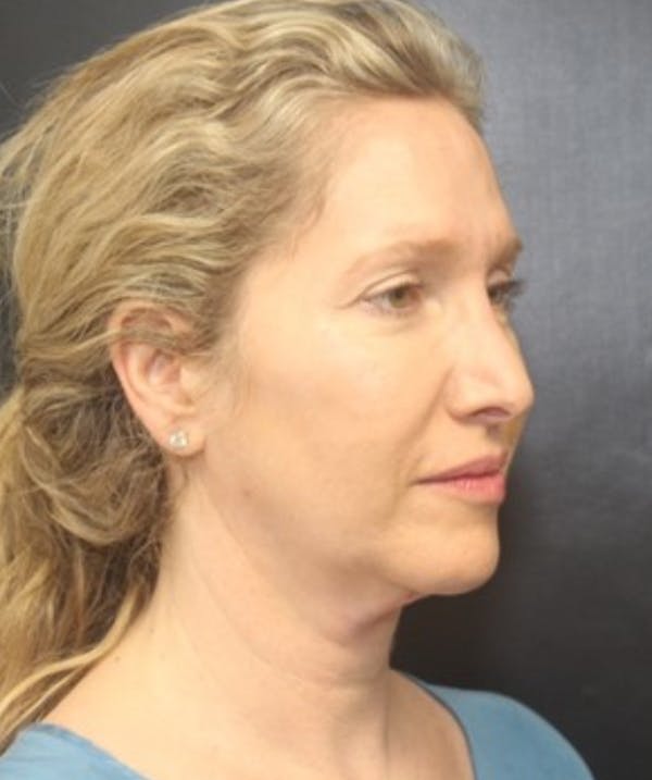 Silhouette Lift  Before & After Gallery - Patient 101411830 - Image 1