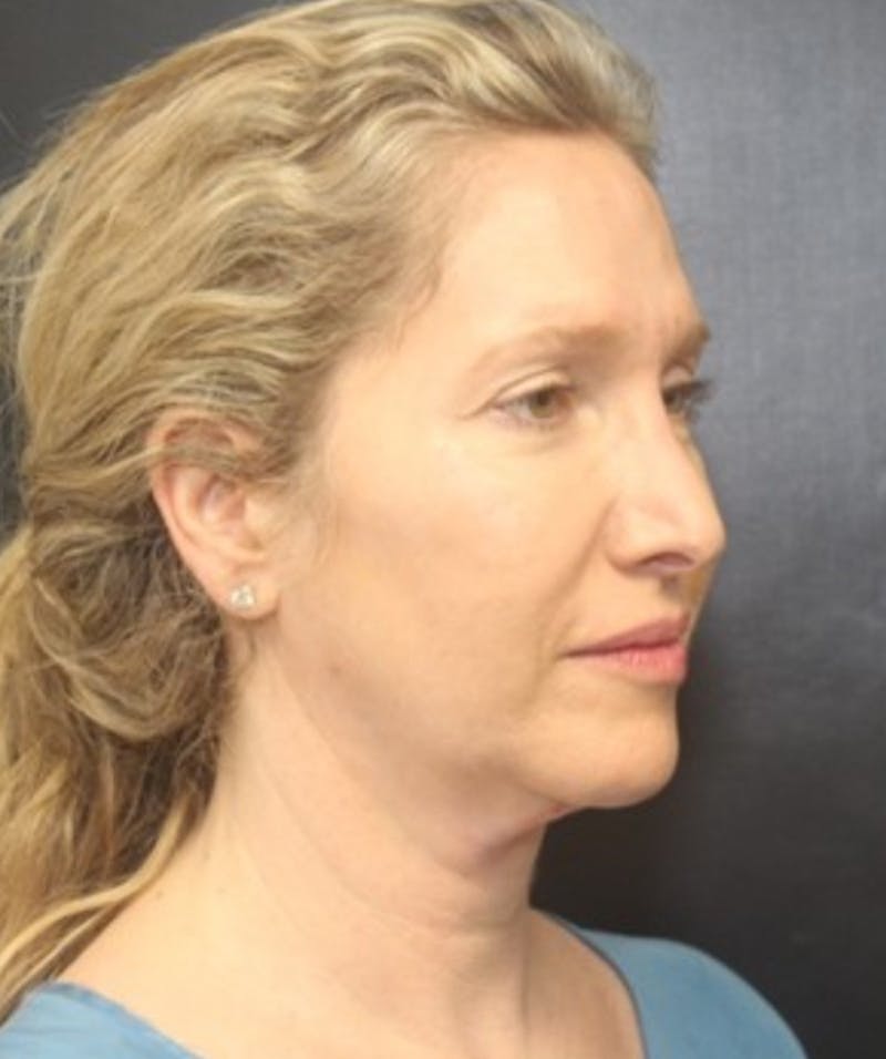 Silhouette Lift  Before & After Gallery - Patient 101411830 - Image 1