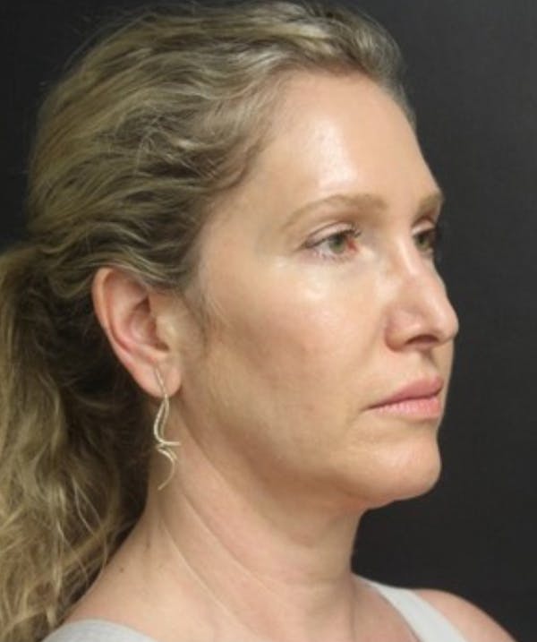 Silhouette Lift  Before & After Gallery - Patient 101411830 - Image 2