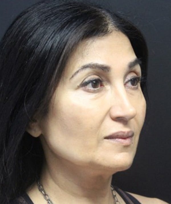 Silhouette Lift  Before & After Gallery - Patient 101411831 - Image 1