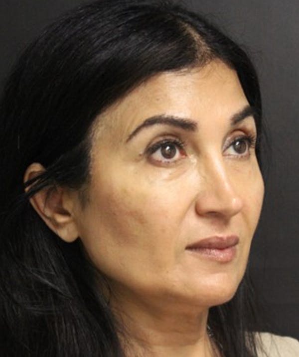 Silhouette Lift  Before & After Gallery - Patient 101411831 - Image 2