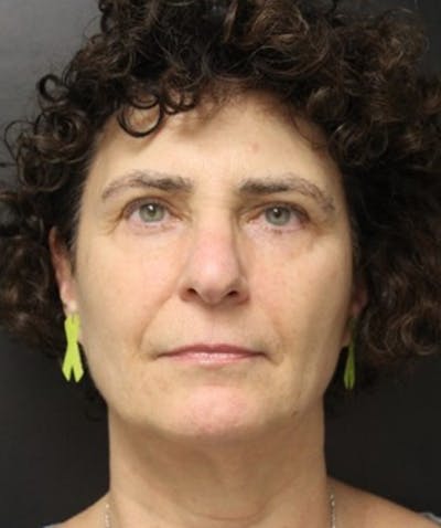 Silhouette Lift  Before & After Gallery - Patient 101411832 - Image 2