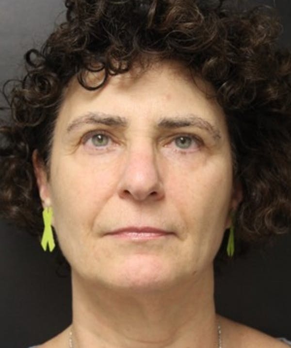 Silhouette Lift  Before & After Gallery - Patient 101411832 - Image 2