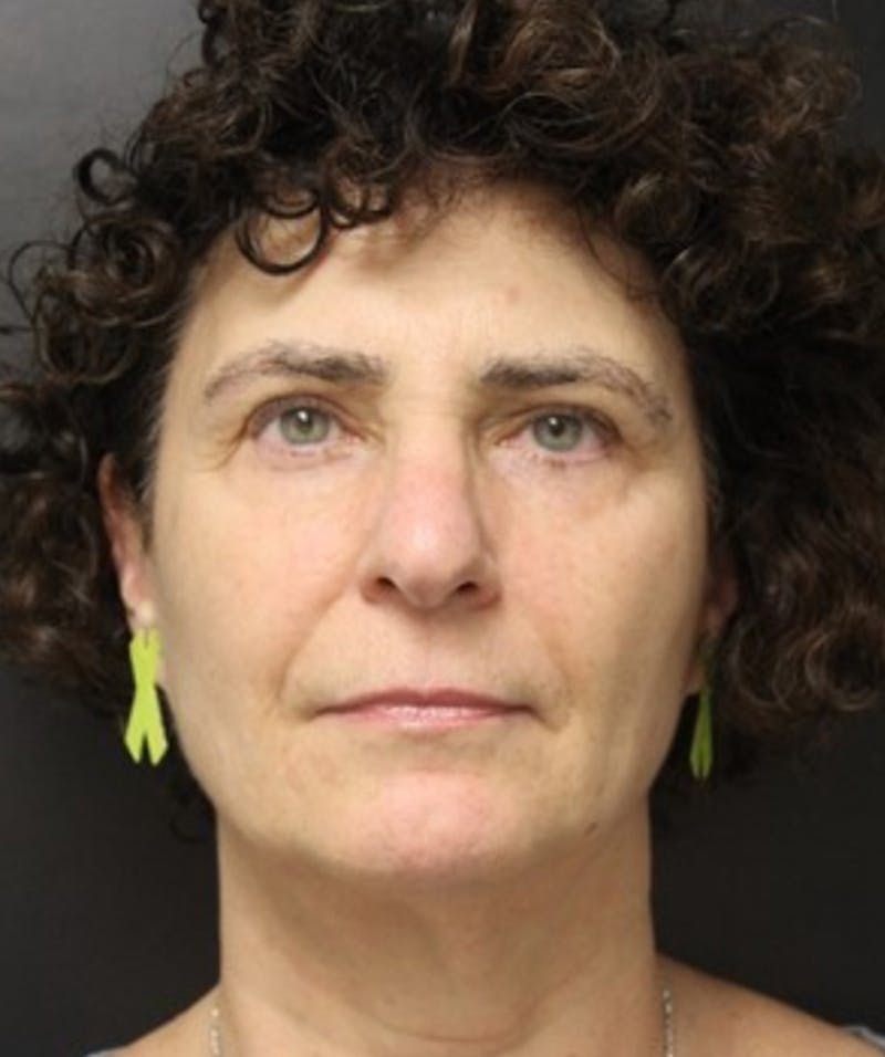 Silhouette Lift  Before & After Gallery - Patient 101411832 - Image 2