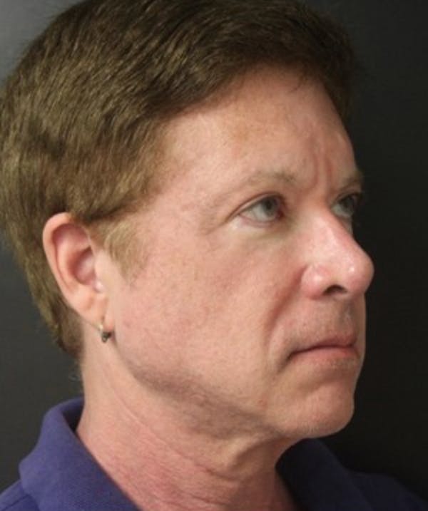 Silhouette Lift  Before & After Gallery - Patient 101411833 - Image 1