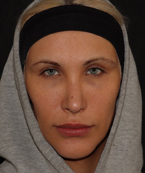 Topilase Before & After Gallery - Patient 101411892 - Image 1