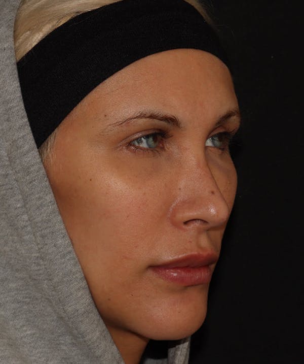 Topilase Before & After Gallery - Patient 101411892 - Image 3