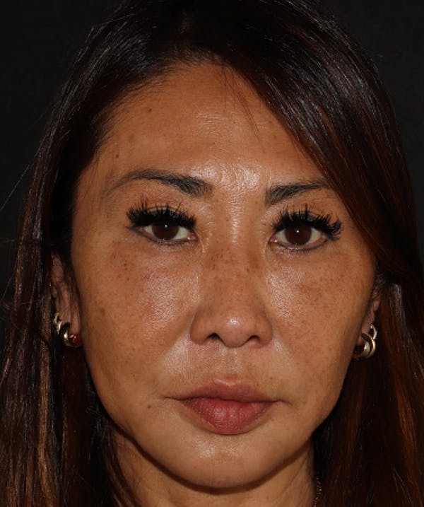 Topilase Before & After Gallery - Patient 101411893 - Image 1