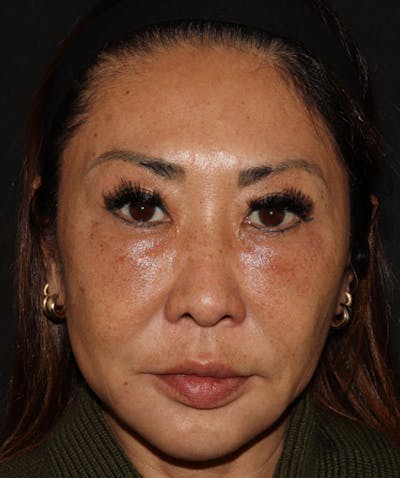 Topilase Before & After Gallery - Patient 101411893 - Image 2