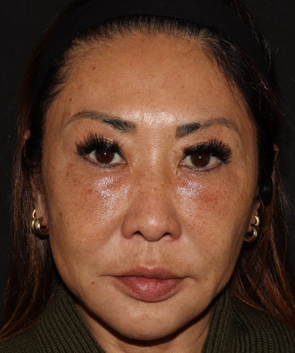 Topilase Before & After Gallery - Patient 101411893 - Image 2