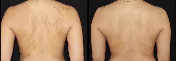 Laser Resurfacing Before & After Gallery - Patient 111638183 - Image 1