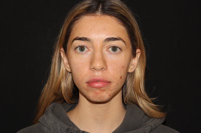 Lip Filler Before & After Gallery - Patient 141186428 - Image 2