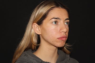 Lip Filler Before & After Gallery - Patient 141186428 - Image 4