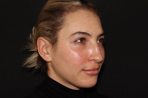 Injectables Gallery - Patient 112555393 - Image 2