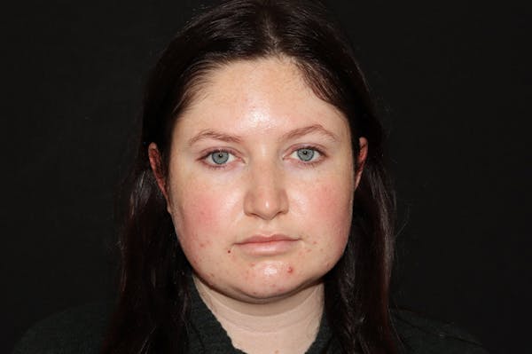 Restylane Before & After Gallery - Patient 141186412 - Image 1