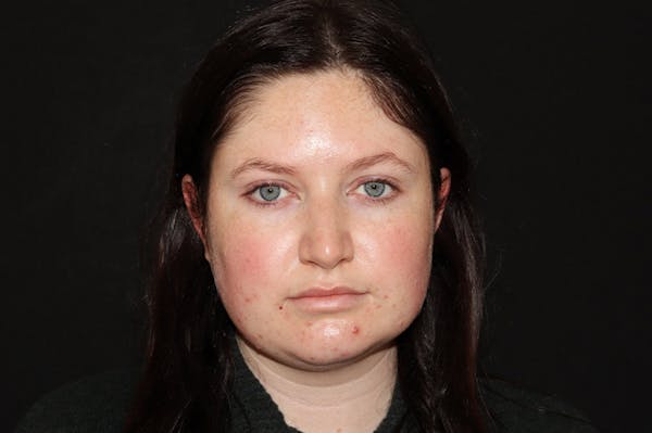 Restylane Before & After Gallery - Patient 141186412 - Image 1