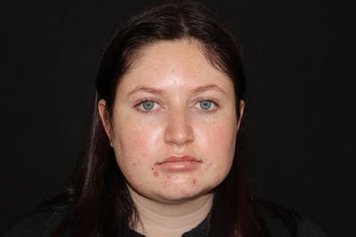 Restylane Before & After Gallery - Patient 141186412 - Image 2