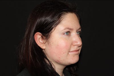 Restylane Before & After Gallery - Patient 141186412 - Image 3