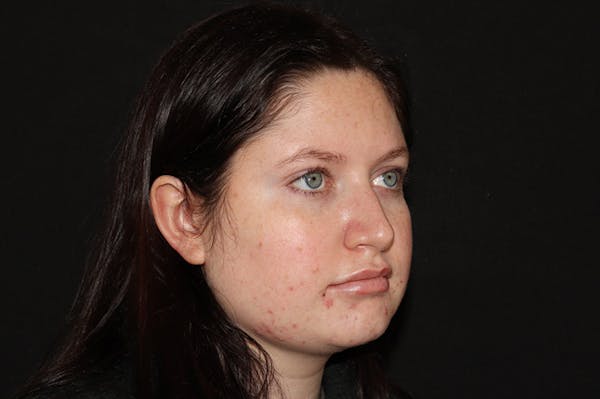 Restylane Before & After Gallery - Patient 141186412 - Image 4