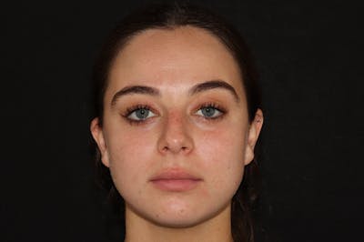Before Lip Filler