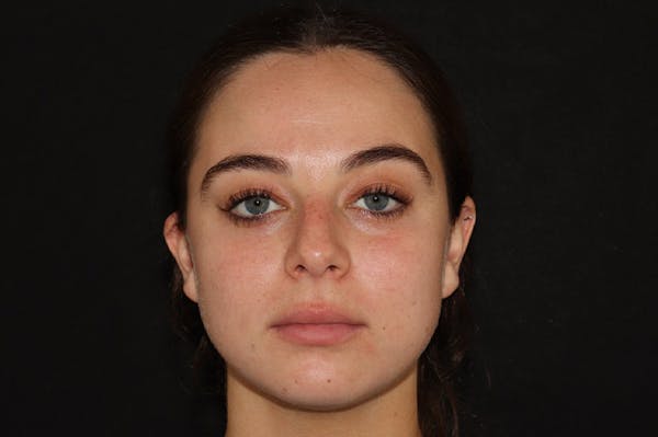 Lip Filler Before & After Gallery - Patient 141186406 - Image 1
