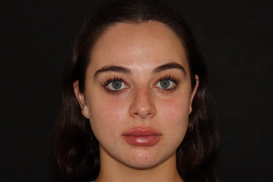 After Lip Filler