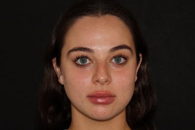 After Lip Filler