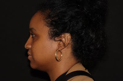 Liquid Rhinoplasty Before & After Gallery - Patient 141186403 - Image 1