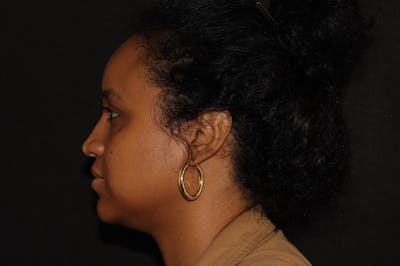 Liquid Rhinoplasty Before & After Gallery - Patient 141186403 - Image 2