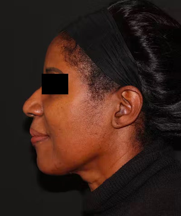 Rhinoplasty Before & After Gallery - Patient 101411693 - Image 1