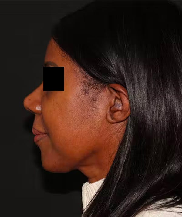 Rhinoplasty Before & After Gallery - Patient 101411693 - Image 2