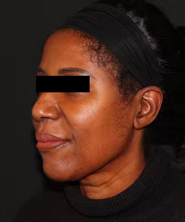 Rhinoplasty Before & After Gallery - Patient 101411693 - Image 3