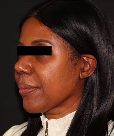 Rhinoplasty Before & After Gallery - Patient 101411693 - Image 4