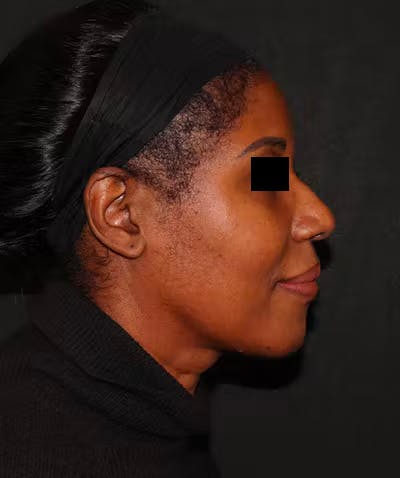 Rhinoplasty Before & After Gallery - Patient 101411693 - Image 5