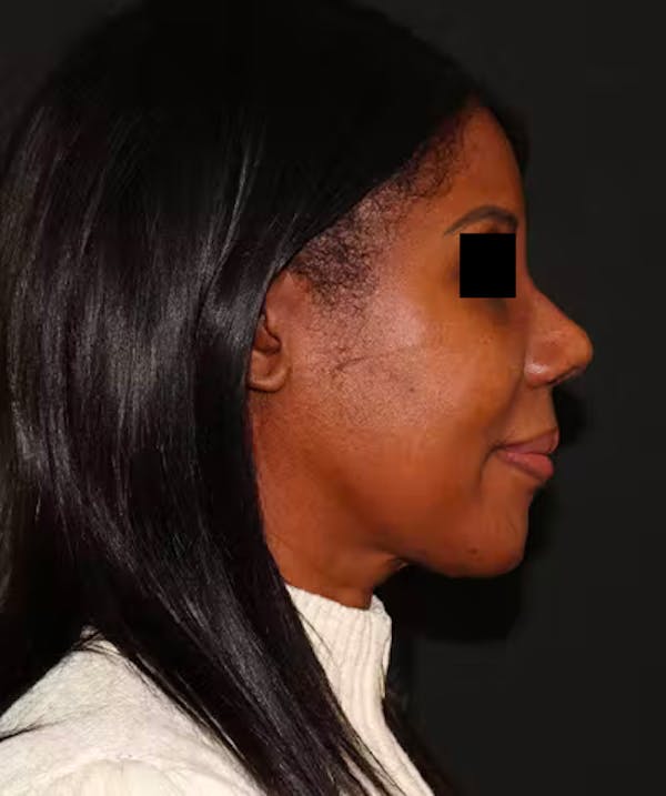 Rhinoplasty Before & After Gallery - Patient 101411693 - Image 6