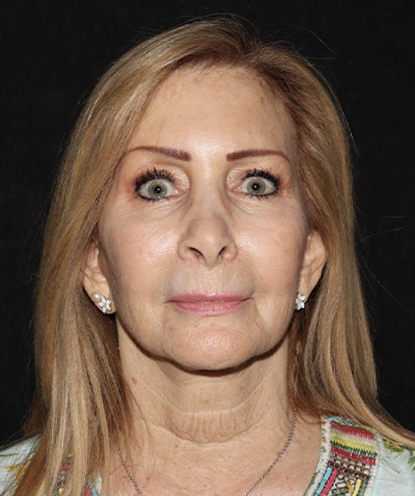 Before & After Facelift in Westchester, New York