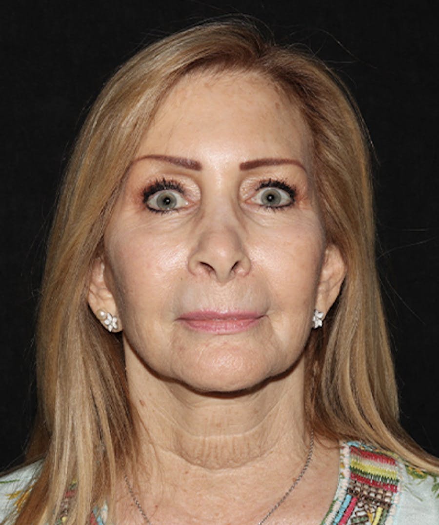 Laser Resurfacing Before & After Gallery - Patient 121258988 - Image 1