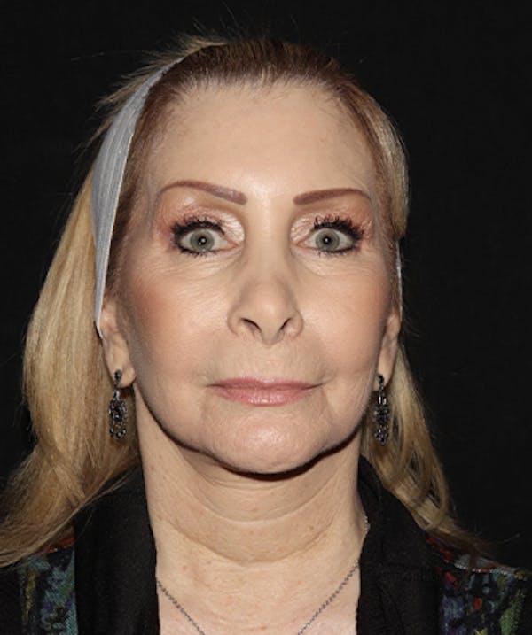 Before & After Facelift in Westchester, New York
