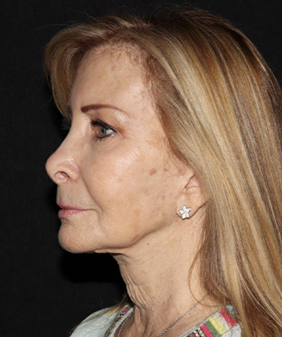 Laser Resurfacing Before & After Gallery - Patient 121258988 - Image 3