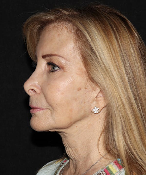 Facelift Before & After Gallery - Patient 121258980 - Image 3