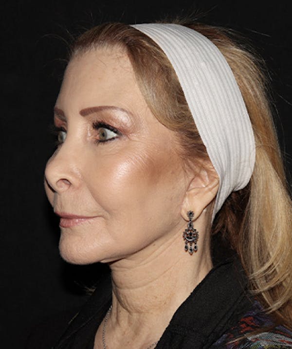Facelift Before & After Gallery - Patient 121258980 - Image 4